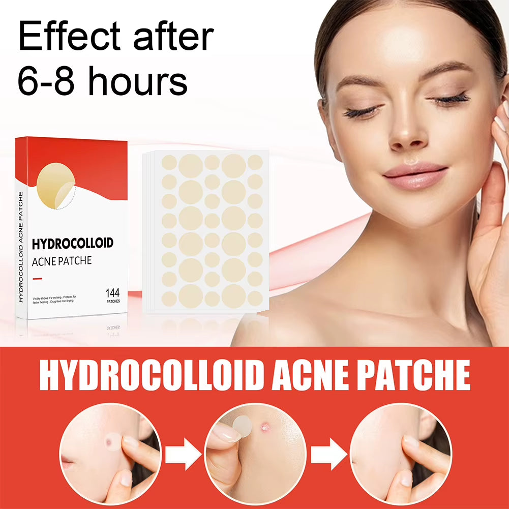 Hydrocolloid Acne Pimple Patches – 144 PCS