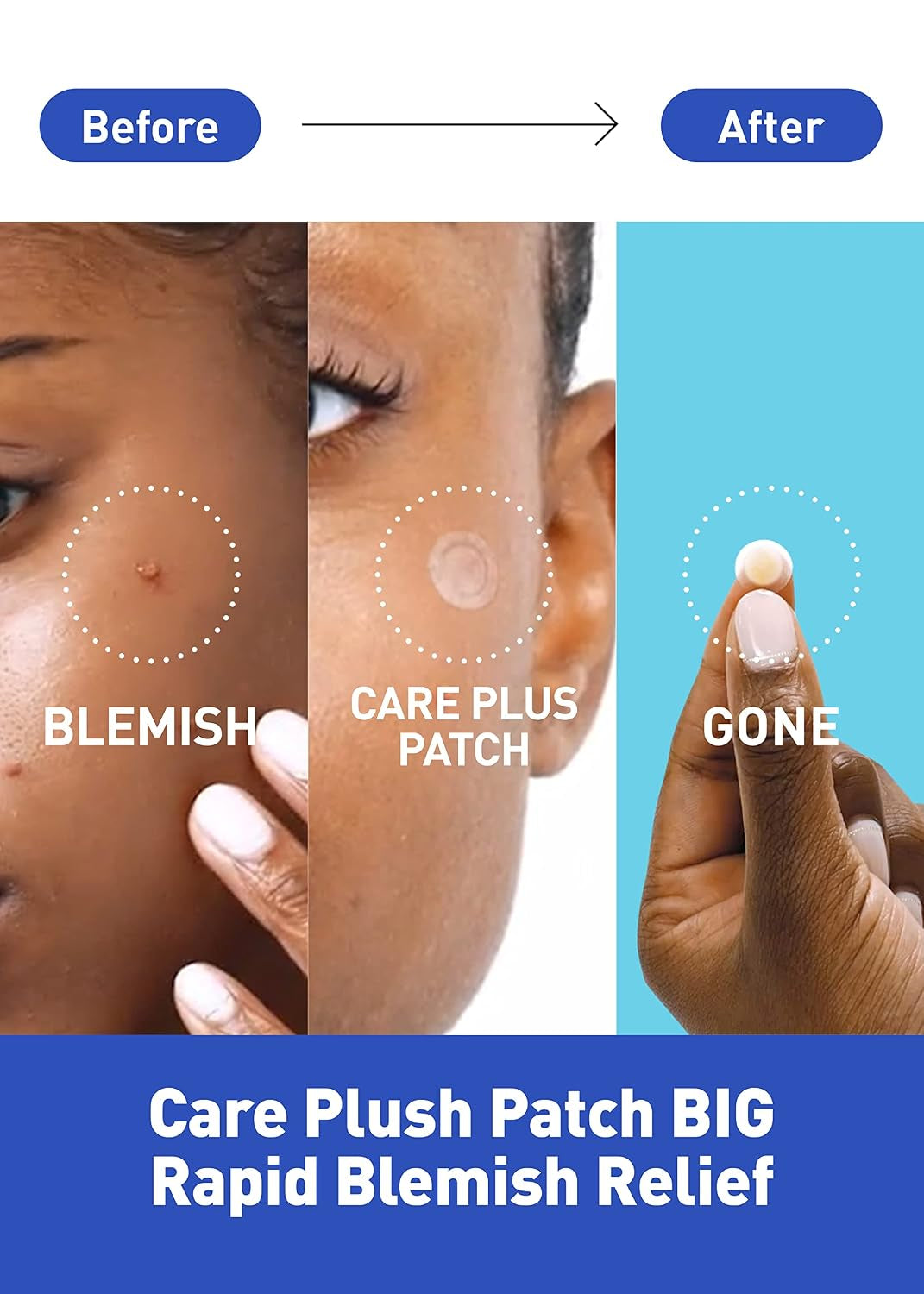 Care Plus Hydrocolloid Acne Pimple Patches | Invisible Korean Spot Patches (306 Count)
