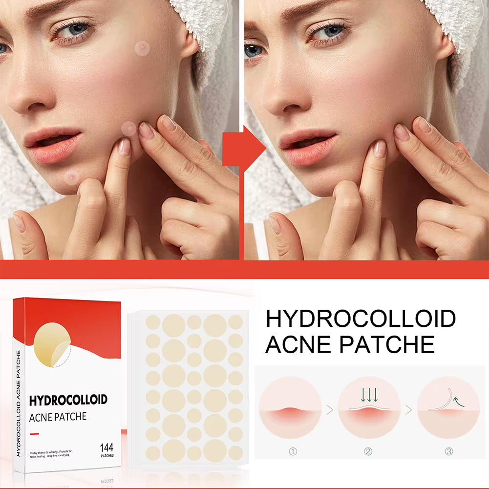 Hydrocolloid Acne Pimple Patches – 144 PCS