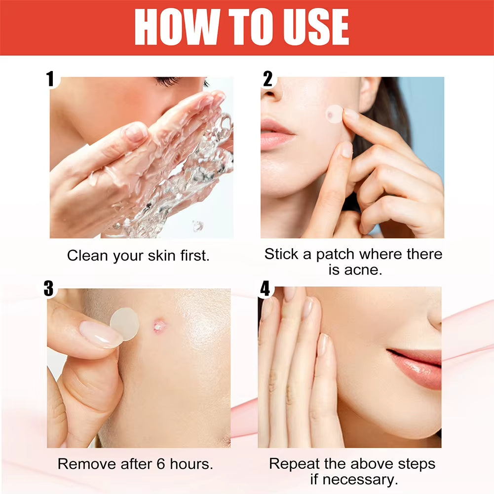 Hydrocolloid Acne Pimple Patches – 144 PCS