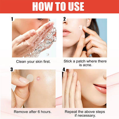 Hydrocolloid Acne Pimple Patches – 144 PCS